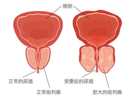 肥大的前列腺导致尿道受压迫